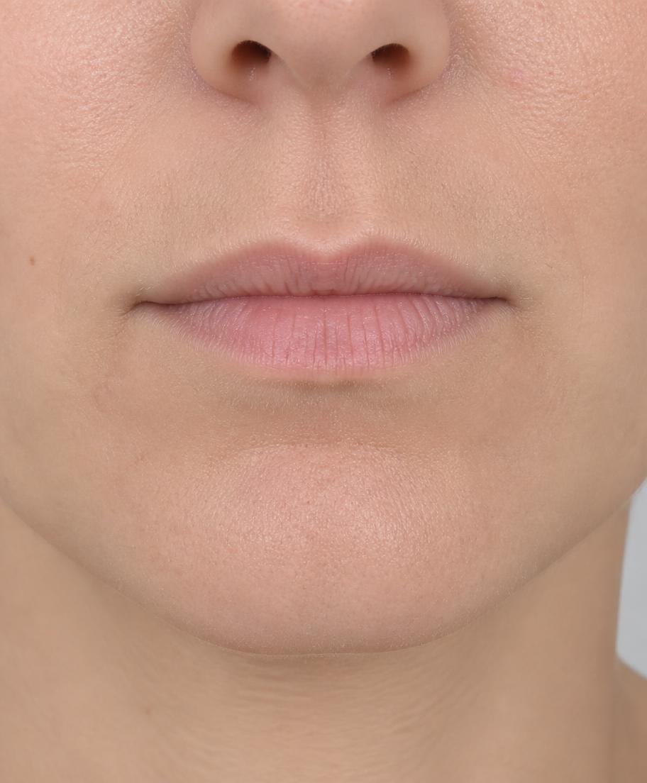 Imagem demonstrativa: lábios antes do preenchimento labial